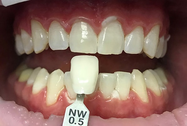 Отбеливание зубов зум 4, до и после