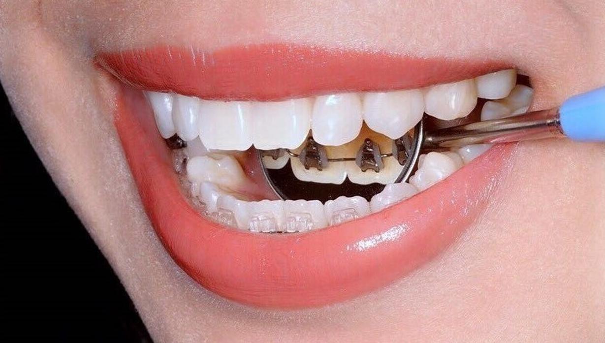 Лингвальные брекеты Incognito и Win: исправления прикуса зубов внутренними брекетами